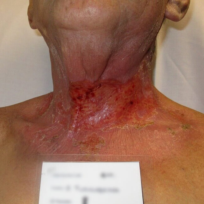Before treatment